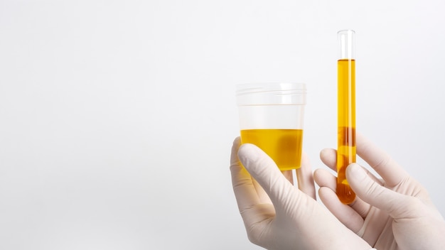 Imagem de teste de urina